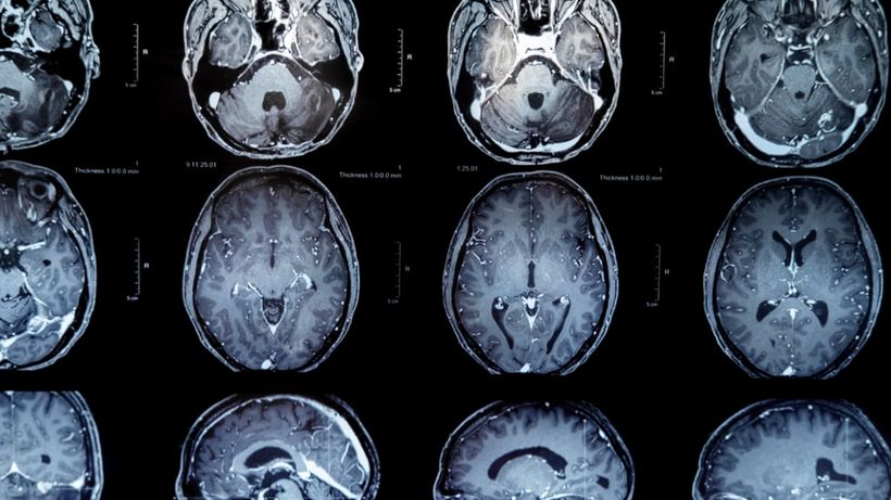 Radiografía del cerebro