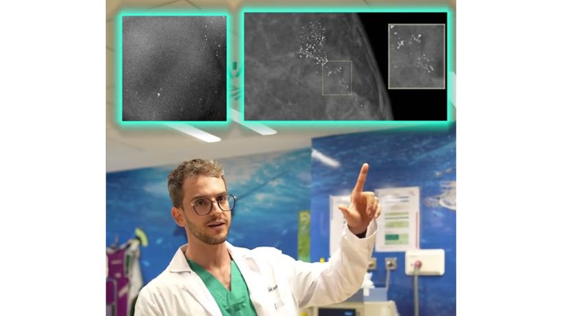 microcalcificaciones desodorante radiografia