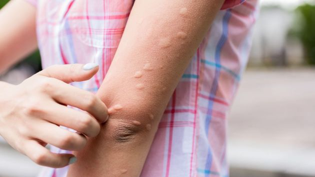 Un brazo con picaduras