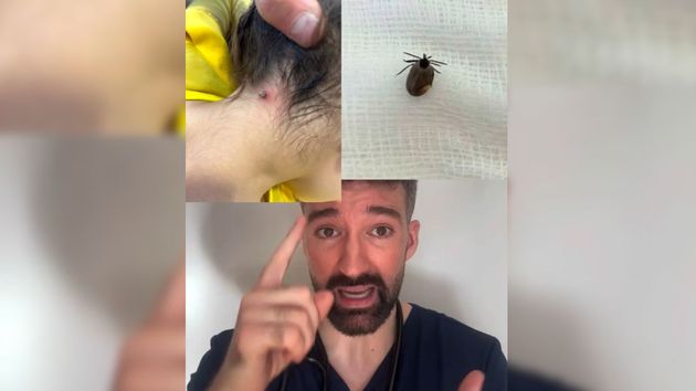 David Callejo y una garrapata