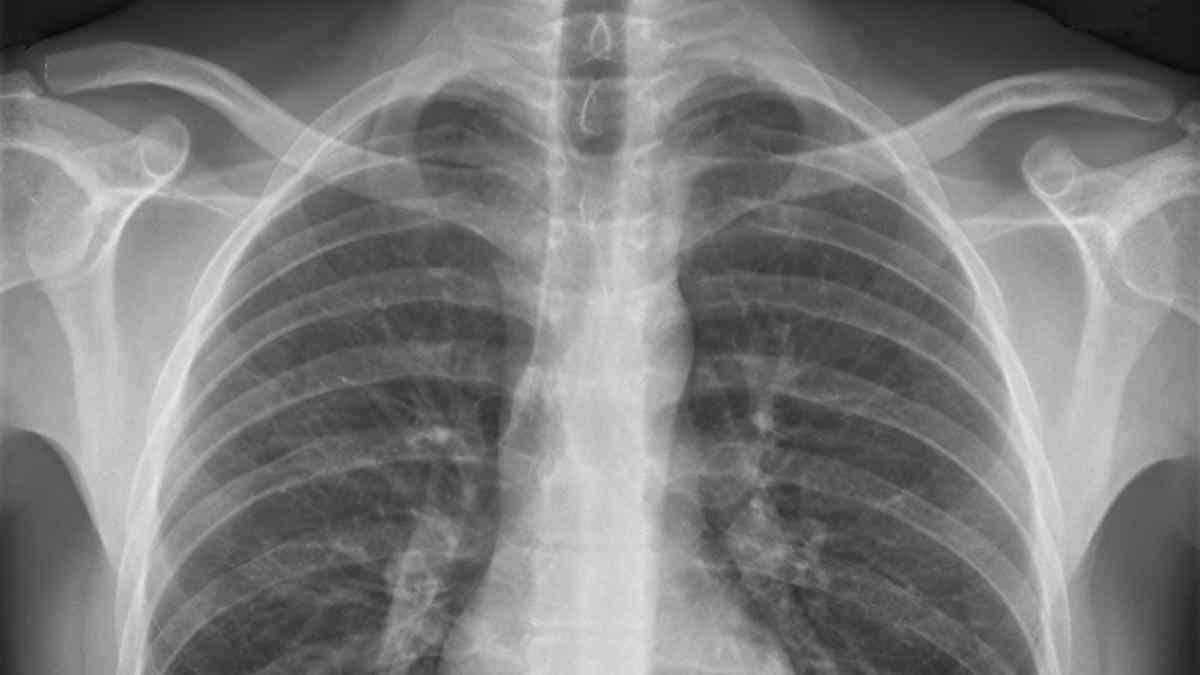 Una radiografía de pulmones