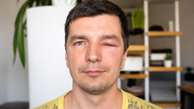 Hombre con lesión en el ojo