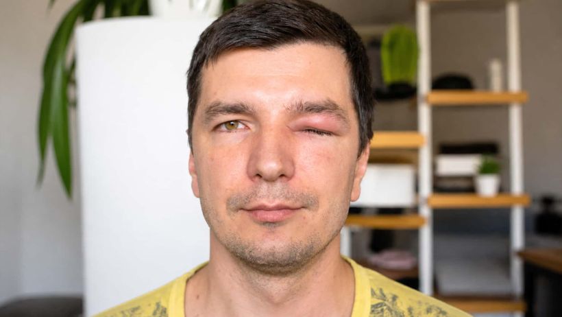 La Seguridad Social le deniega la incapacidad permanente tras perder un ojo y agotar los 545 de incapacidad temporal y la justicia obliga al INSS a darle la razón
